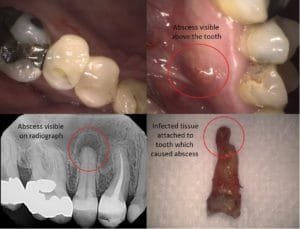 Guelph Dentist, Tooth removal, Root Canal