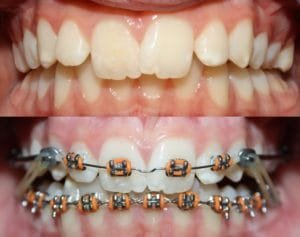 Orthodontics. Guelph, Carriere Appliance, Braces