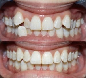 Invisalign Guelph