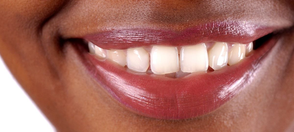 The value of a straight smile