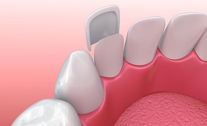 Here’s How Dental Veneers Can Get You Perfect Teeth Like The Celebrities
