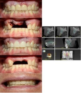 Dental Implants Guelph