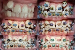 Guelph Dentist, Dentist in Guelph, Guelph Orthodontics, Guelph Braces