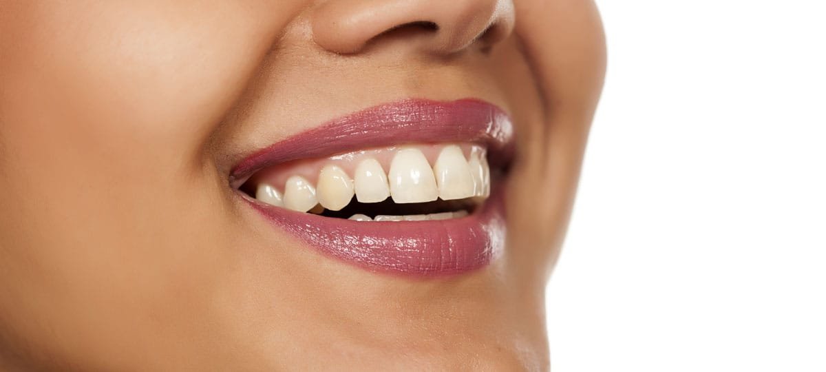 The Lunchtime Gum Lift: Pinhole Gum Grafting is a Newer Way to Treat Gum Recession
