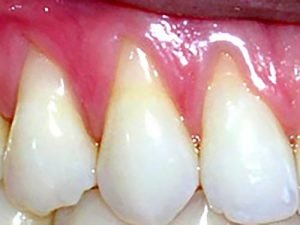 Guelph Village Dental gum surgery - Before