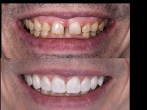 Advantages of Veneers,