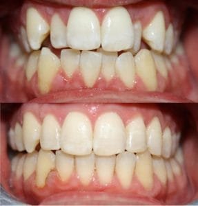 invisalign