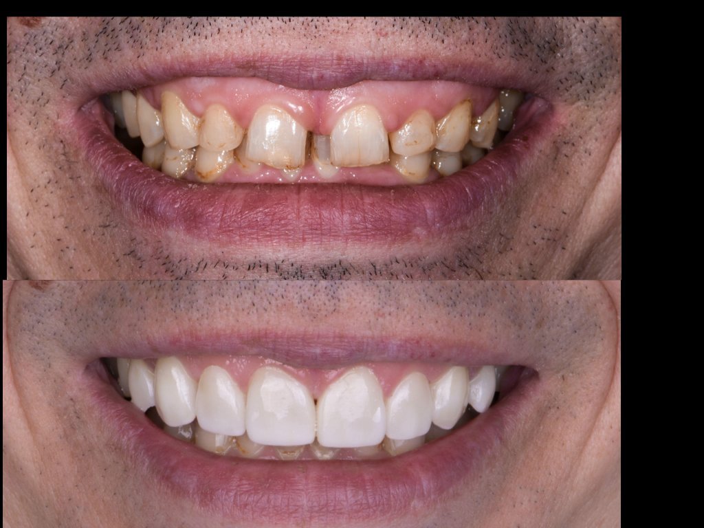Composite Veneers vs Porcelain Veneers - What's the Difference?