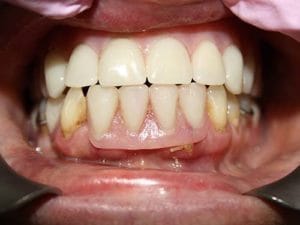 Guelph Dental Dentures