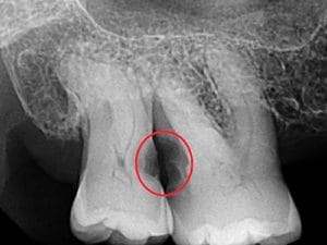 Guelph Dental Extractions