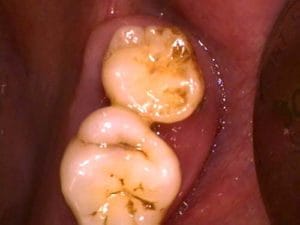 Guelph Dental Extractions
