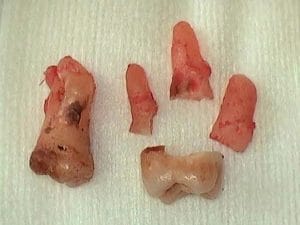 Guelph Dental Extractions