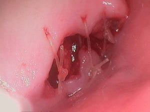 Guelph Dental Extractions
