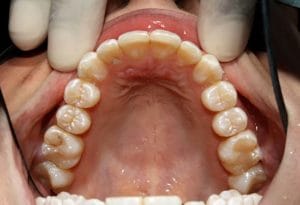 Guelph Dental example 1 - After 8 months of active Invisalign treatment