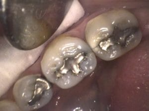Guelph Dental silver fillings replacement process
