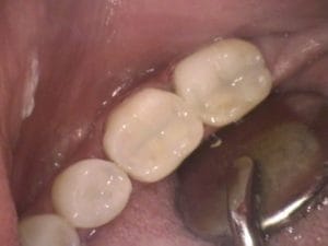 Guelph Dental silver fillings replacement process