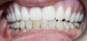 Guelph Dental Dentures After