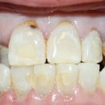 Guelph Dental Dentures Before