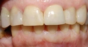 Patient presented with discoloured fillings and teeth